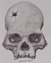 Trepannierter Schädel, aus 